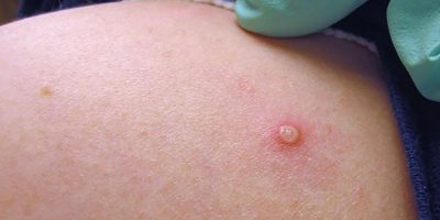 Monkeypox: What you need to know￼