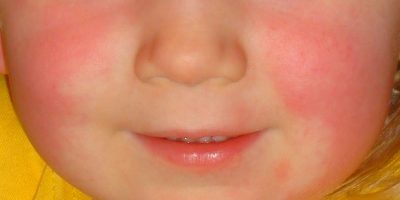 Scarlet Fever: When Should Your Worry?